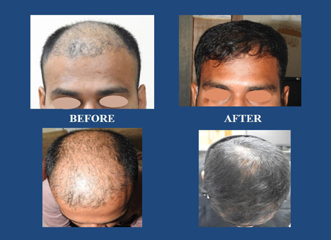 DCGI approved QR 678 formulation proves to be a differentiator from  traditional hair transplant treatment